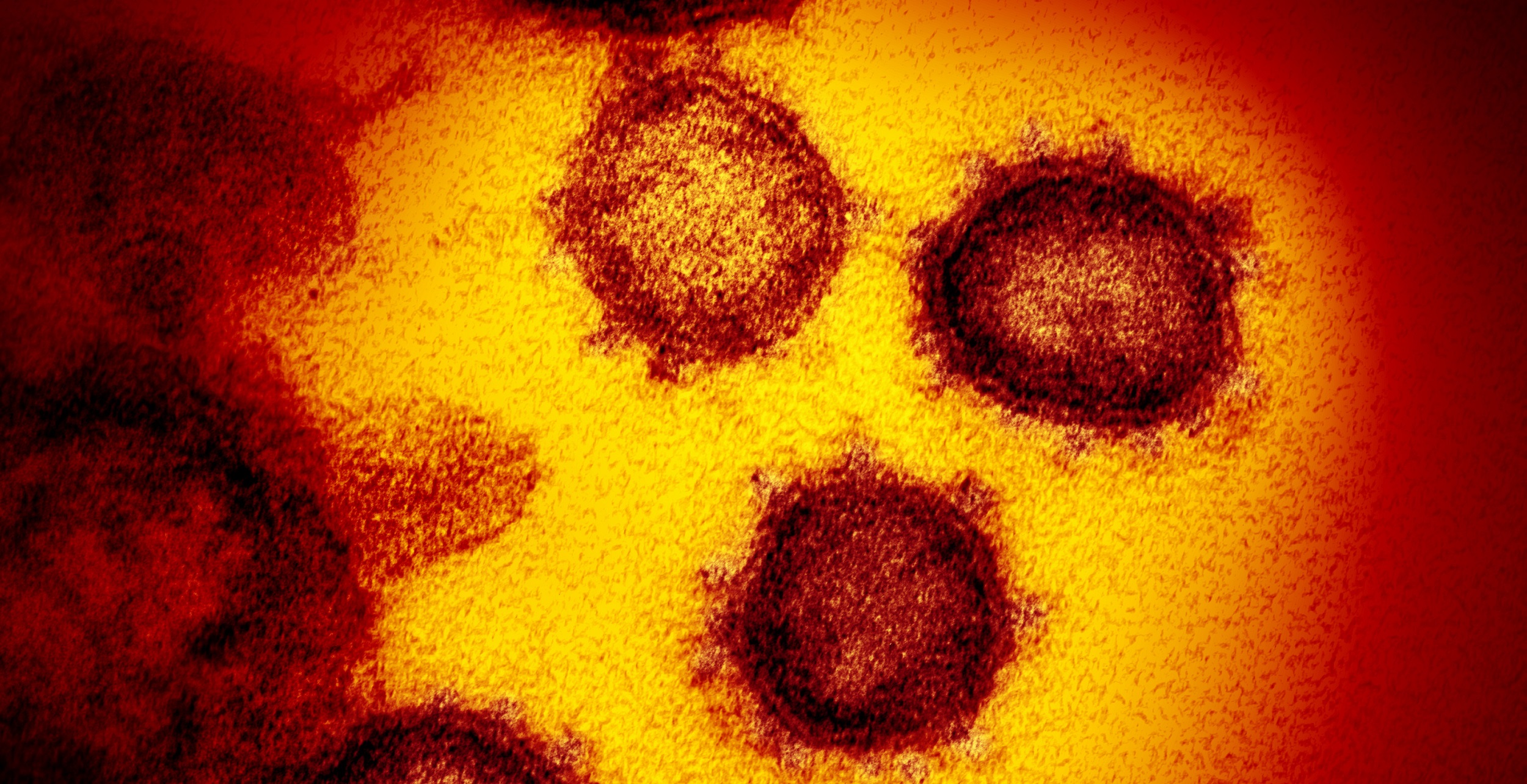 La COVID persistente es una condición que puede aparecer tras una infección por SARS-CoV-2 y una vez superada la COVID-19 (en la imagen, coronavirus SARS-CoV-2 al microscopio).