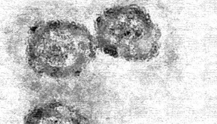 Imagen al microscopio del virus de la hepatitis C.