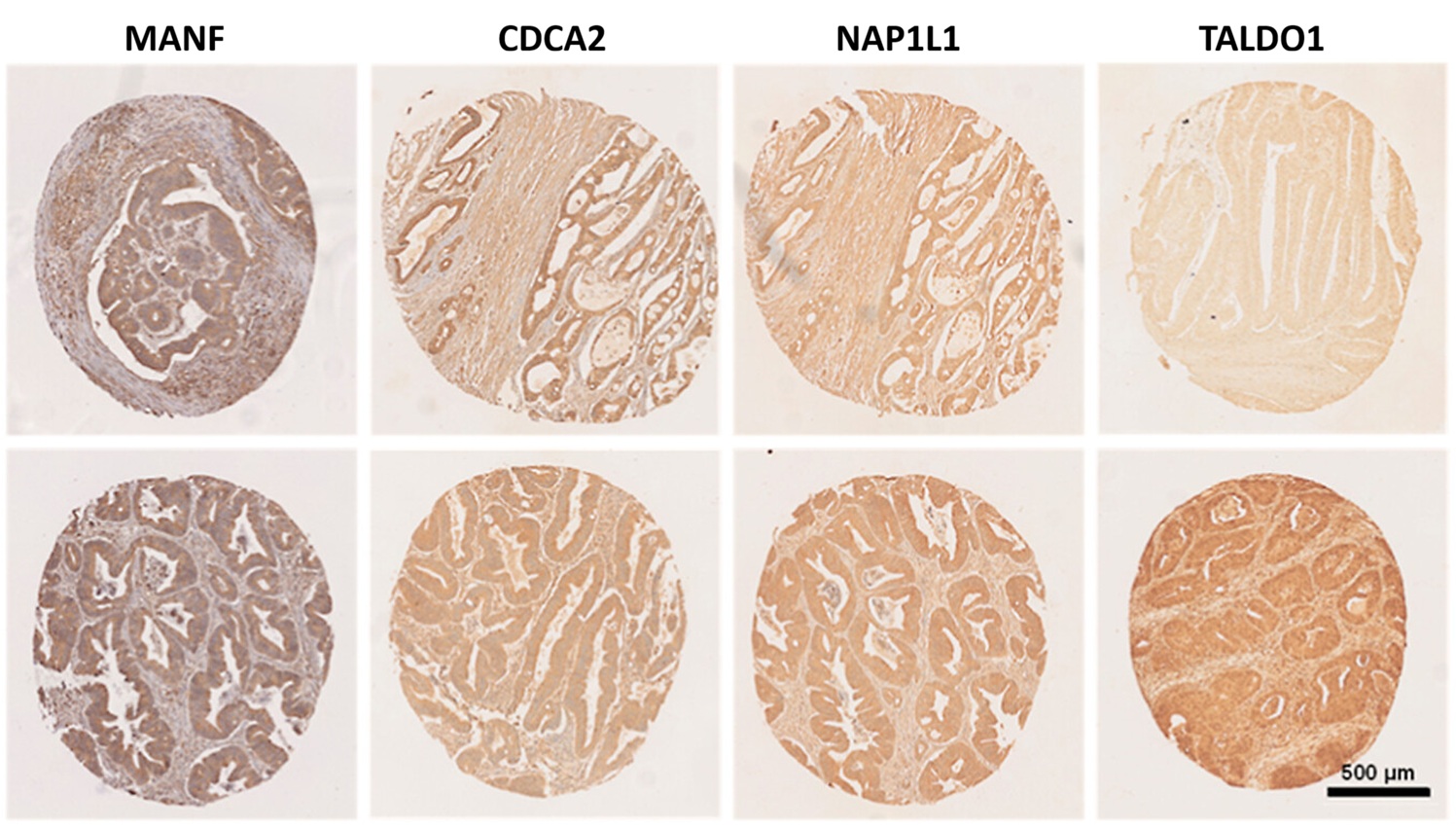 Tinción inmunohistoquímica de las proteínas MANF, CDCA2, NAP1L1 y TALDO1 en muestras de tejido de cáncer colorrectal. En la parte superior se ven tejidos de cáncer no recurrente, y en la inferior, de tumores recurrentes (imagen: J. Proteome Res. 2026, 25, 5, 2385–2399). 